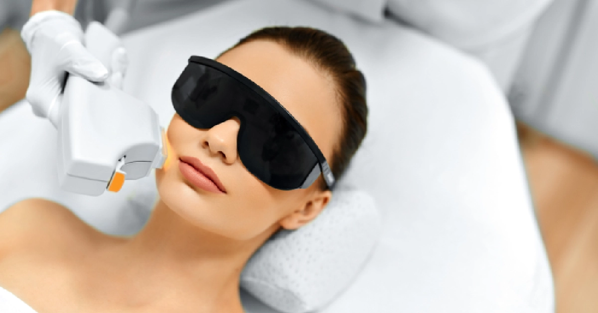 IPL Photo Facial for Sun Damage, Redness, and Pigmentation
